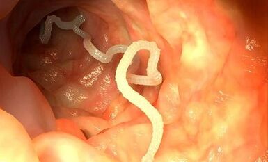 parazītu cēloņi cilvēka organismā